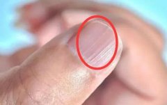 指甲上有豎紋是怎么回事?指甲上有黑線